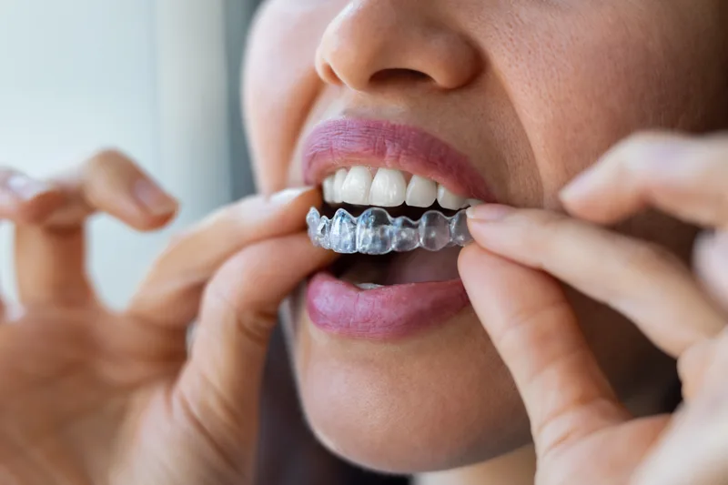 Close-up of a person pressing a clear aligner onto their upper teeth