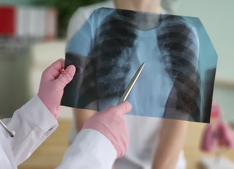 A clinician pointing a pen at an X-ray film held up to the light
