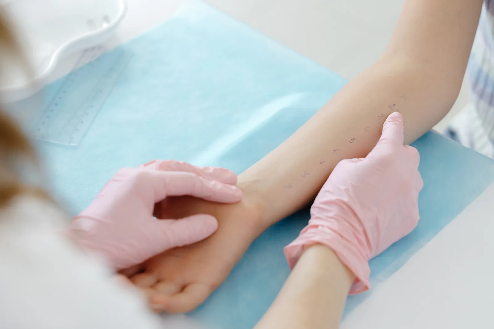 Allergist administering a skin prick allergy test on a patient's forearm in a clinic exam room