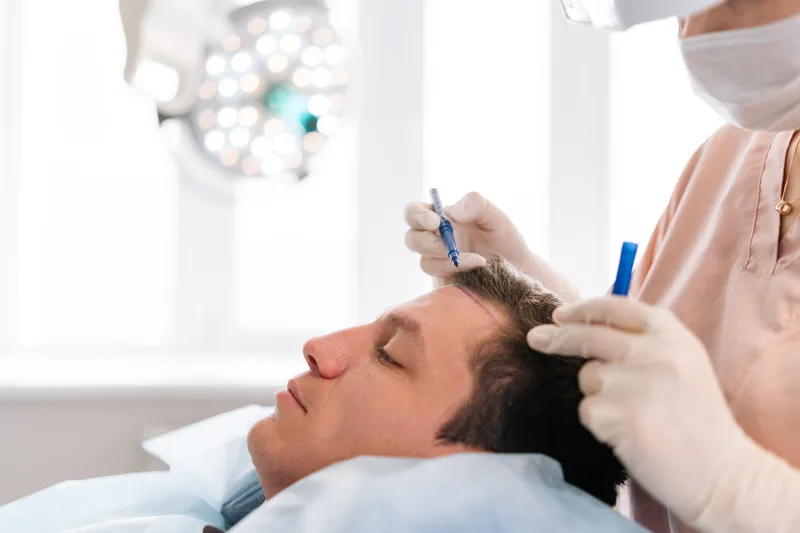 Surgeon marking a new hairline on a patient before a hair transplant procedure
