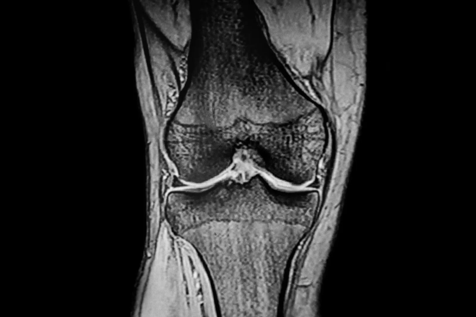 Orthopedic surgeon reviewing a knee X-ray with a patient during a consultation