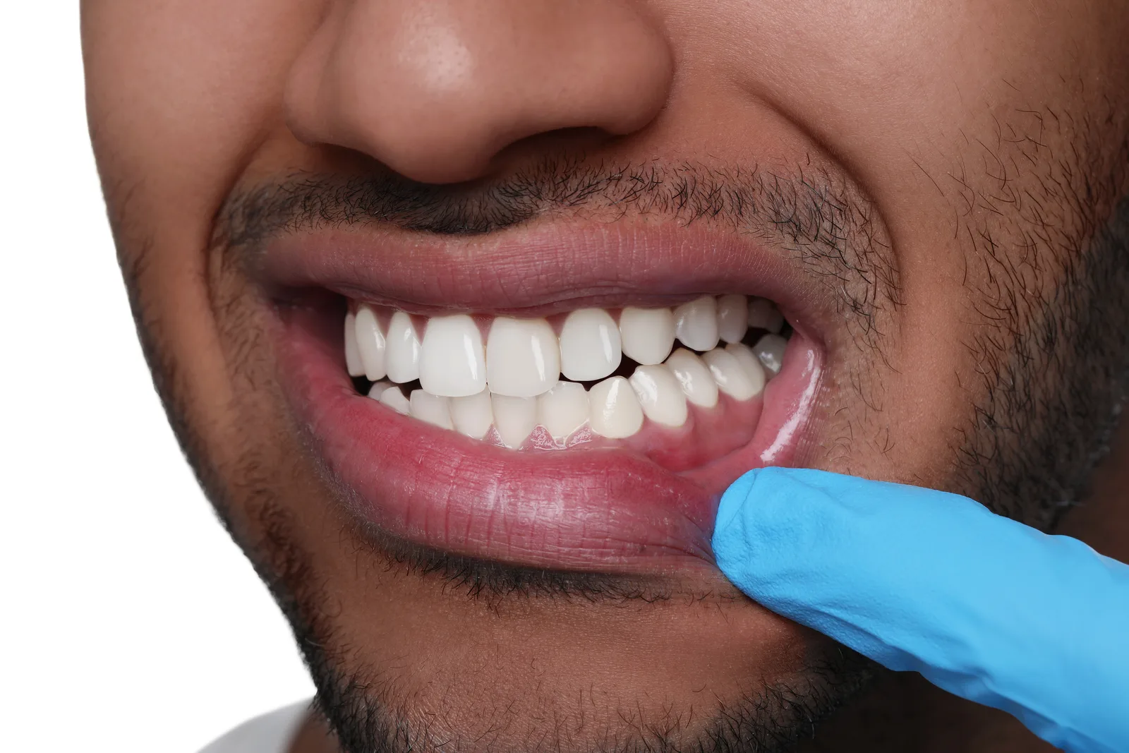 Periodontist in gloves examining a patient's gums with a dental mirror during a periodontal exam